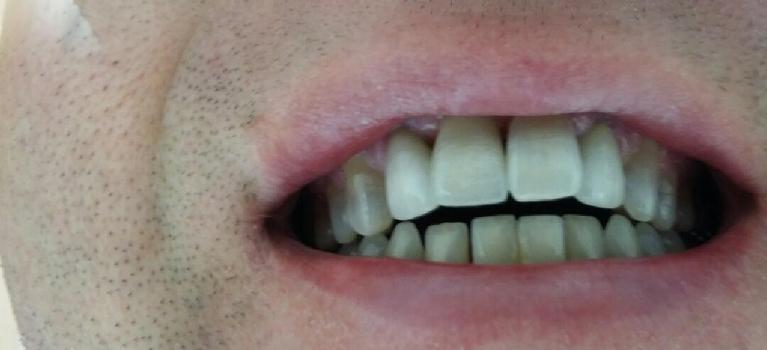 Single-Implant-Crown-After-Image