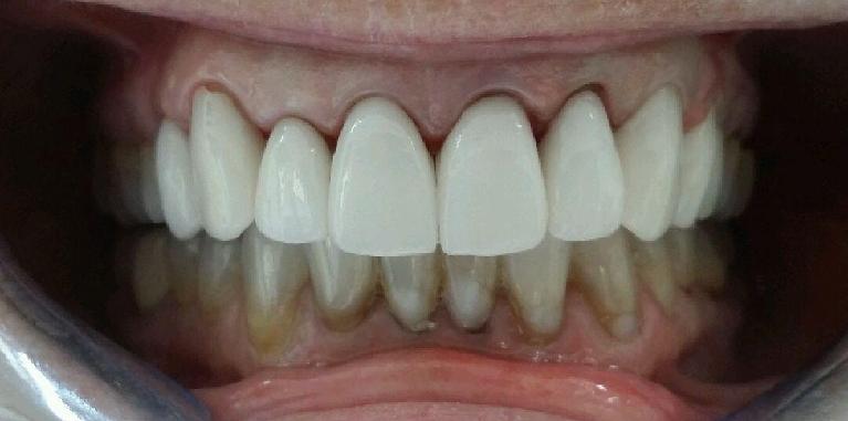 Upper-Porcelain-Crowns-and-Veneers-After-Image