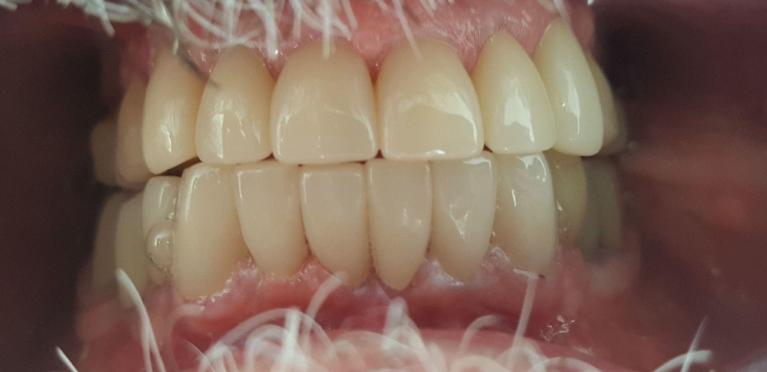 Upper-and-Lower-Porcelain-Crowns-After-Image