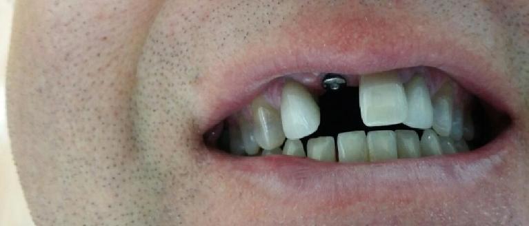 Single-Implant-Crown-Before-Image
