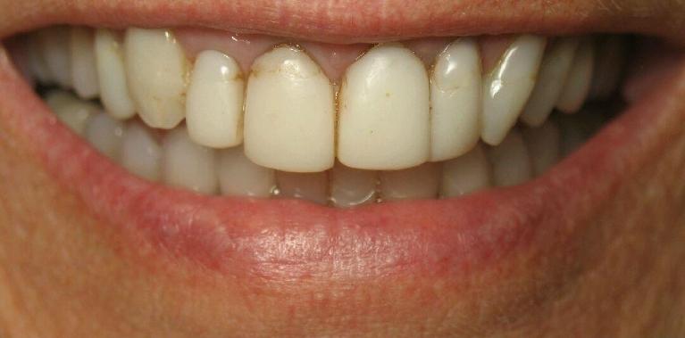 Upper-Porcelain-Crowns-and-Veneers-Before-Image