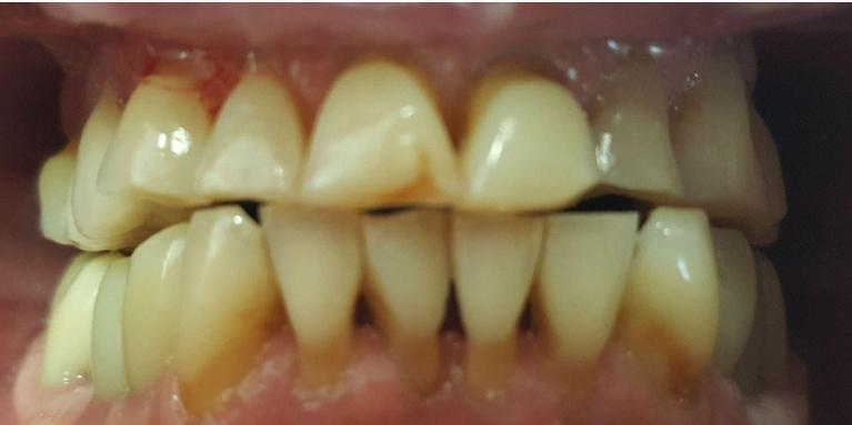 Upper-and-Lower-Porcelain-Crowns-Before-Image